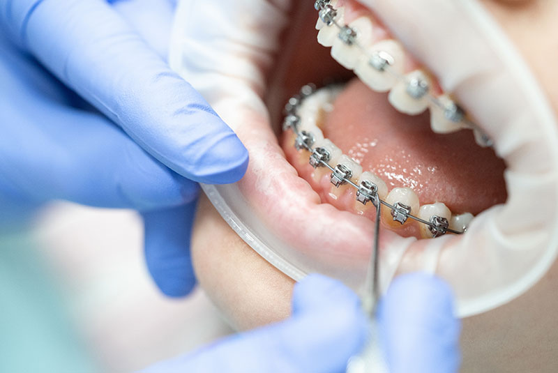 doctor working on patient with braces