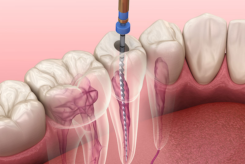 Root canal
