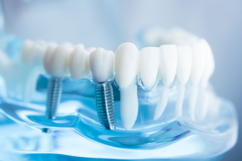 dental implant model.