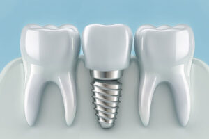 a dental implant with a one tooth extraction in the middle of both teeth