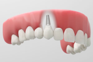 Dental implant replacing a missing front tooth in the upper jaw.