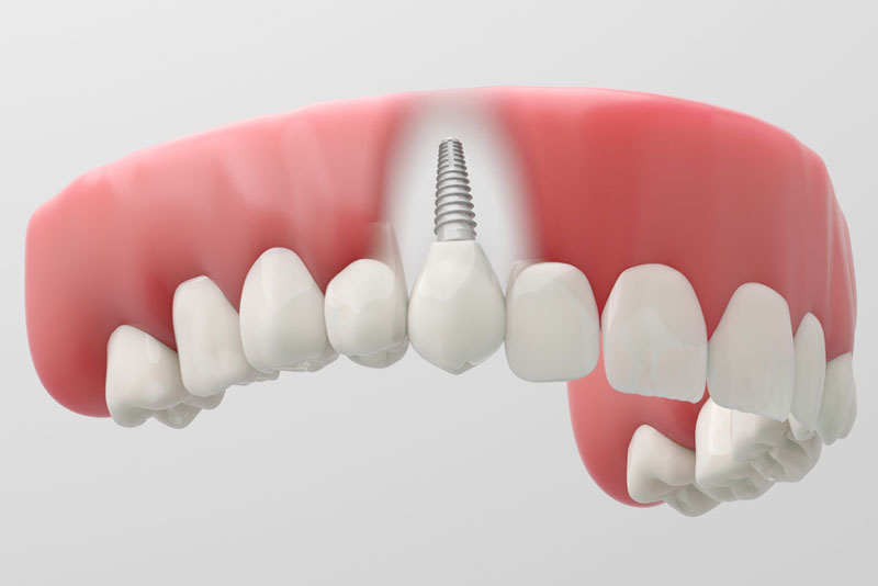 Dental implant replacing a missing front tooth in the upper jaw.
