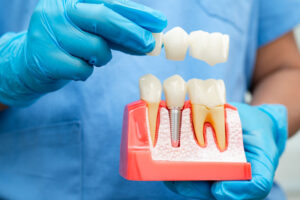 A dental professional wearing blue gloves holds a model showing a dental implant with a crown bridge, demonstrating how implants replace missing teeth.